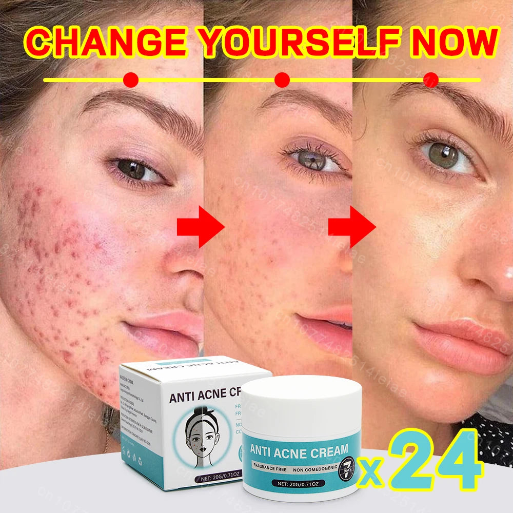 Remove acne, blackheads, shrink pores, and reduce acne marks