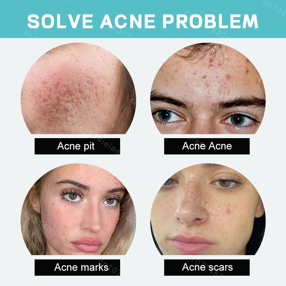 Remove acne, blackheads, shrink pores, and reduce acne marks