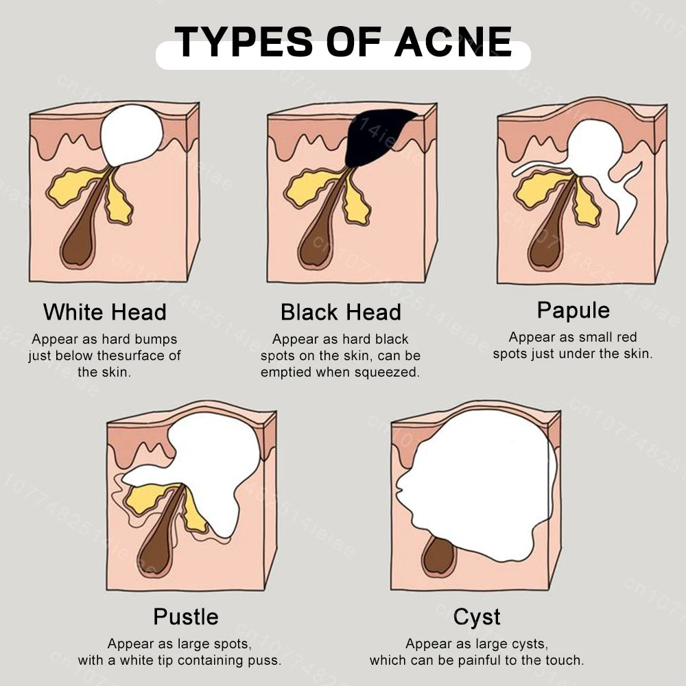 Remove acne, blackheads, shrink pores, and reduce acne marks