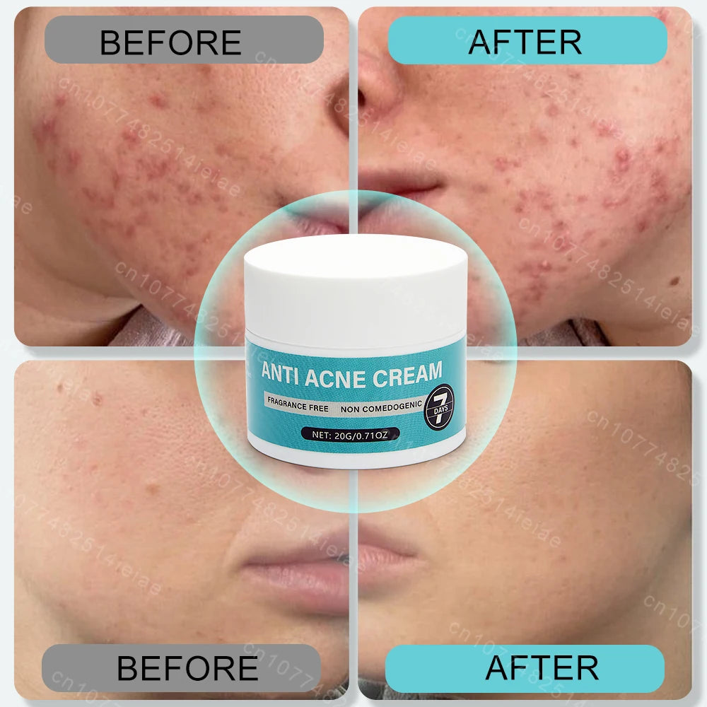 Remove acne, blackheads, shrink pores, and reduce acne marks